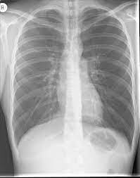 1 PA chest X-ray showing consolidation in the right lower lobe with air bronchograms.